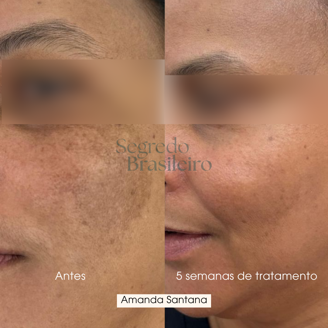 Sérum Anti Melasma - Segredo Brasileiro
