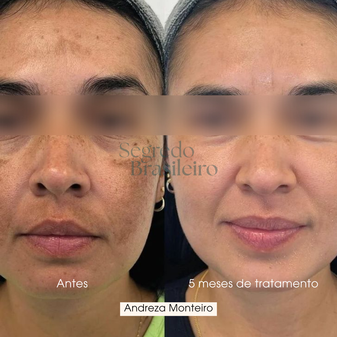 Sérum Anti Melasma - Segredo Brasileiro