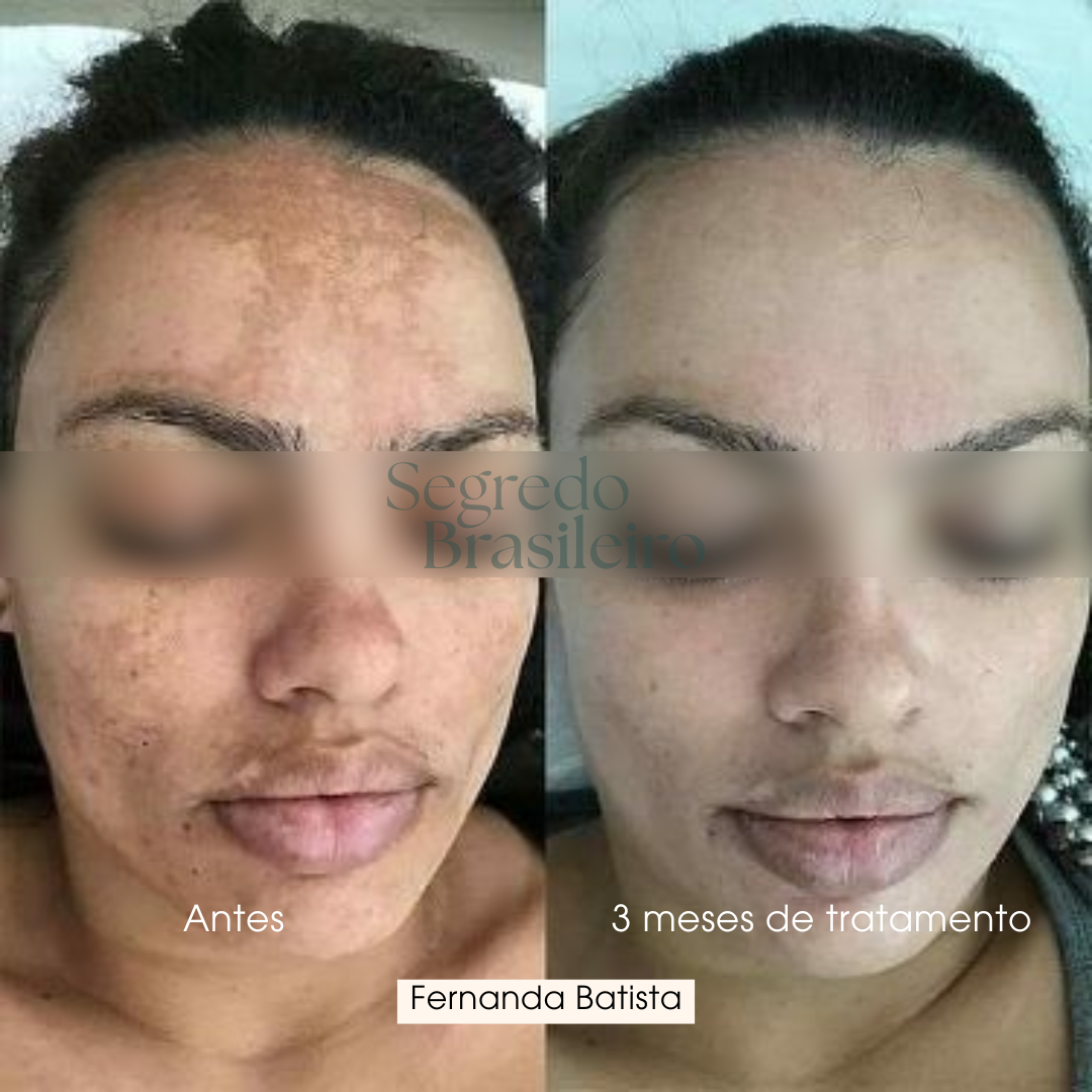 Sérum Anti Melasma - Segredo Brasileiro
